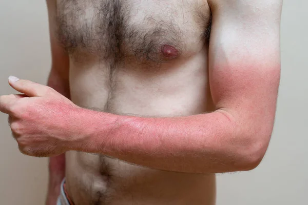 Joven Hombre Caucásico Con Quemaduras Sol Brazos Piel Roja —  Fotos de Stock