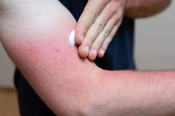 Young Caucasian Man Sunburn Red Skin Arms Applying Sunscreen Cream — Stock Photo, Image