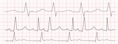 Kırmızı grafik kağıdında siyah kalp atışı diyagramları. EKG elektrokardiyogram şeması. Kalp ritmi çizgisi. Kardiyo testleri. Vektör grafik illüstrasyonu.
