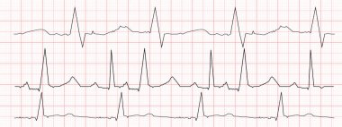 Kırmızı grafik kağıdında siyah kalp atışı diyagramları. EKG elektrokardiyogram şeması. Kalp ritmi çizgisi. Kardiyo testleri. Vektör grafik illüstrasyonu.
