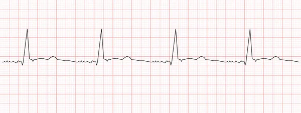 Черное Сердце Бьется Диаграммой Красной Бумаге Пример Схемы Электрокардиограммы Сердечный — стоковый вектор