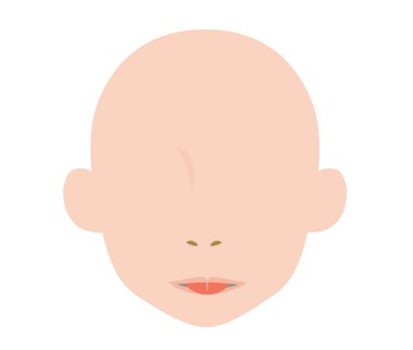 Velofaringeal kısalma nedeniyle gerilemeyen bir dilin tasviri