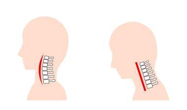 This is an illustration of a neck pain due to a smart phone neck (straight neck).