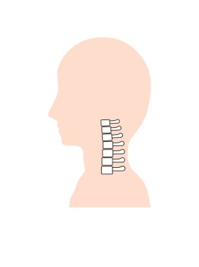 This is an illustration of kyphosis, an abnormality of the cervical spine.