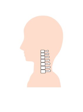 This is an illustration of a neck pain due to a smart phone neck (straight neck).