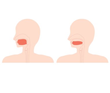 Doğru dil pozisyonu ve düşük dil (normal pozisyonda değil)