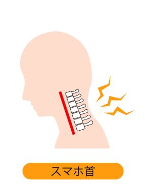 This is an illustration of a neck pain due to a smart phone neck (straight neck).