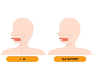 Normal dil ve dilin çizimi, süratin kısalması nedeniyle genişletilemiyor.