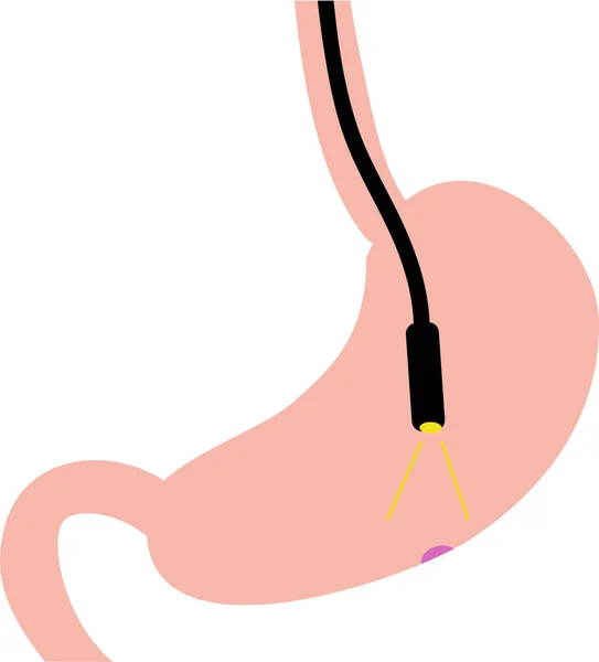 Klipart Zobrazující Gastroskopii Vyšetření Polypu Žaludku — Stockový vektor