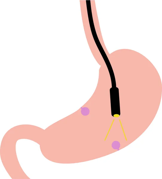 Clip Art Que Representa Gastroscopia Examen Pólipo Gástrico — Archivo Imágenes Vectoriales