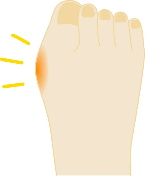 Болезненная Иллюстрация Большого Пальца Ноги Ноги — стоковый вектор