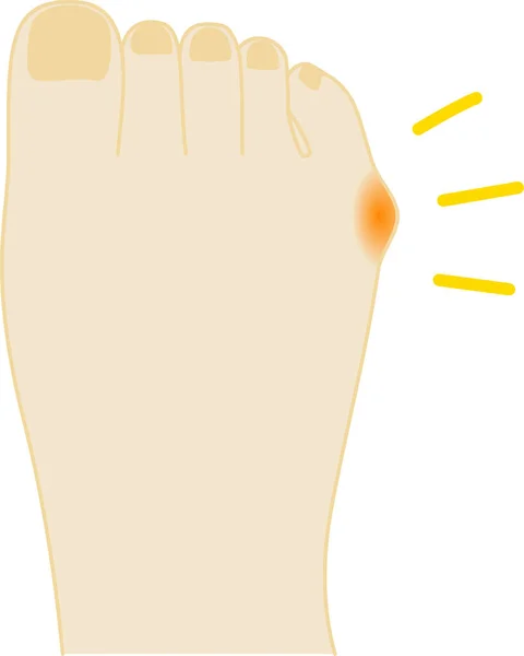 Hallux Valgus Pain Foot Illustration — Stock Vector