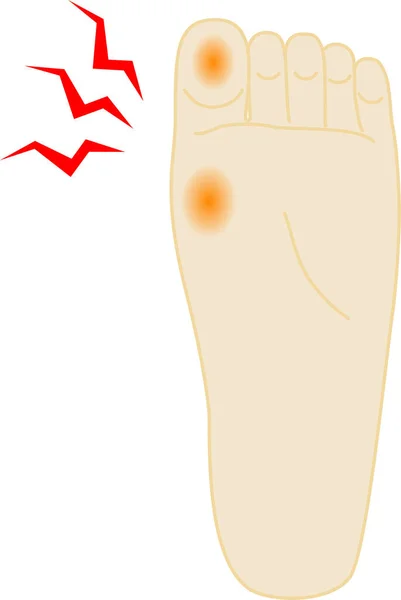 Painful Callus Illustration Foot — Stock Vector