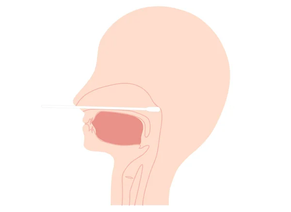 Nasofarynxswabvloeistof Monsterverzameldiagram Illustratie — Stockvector