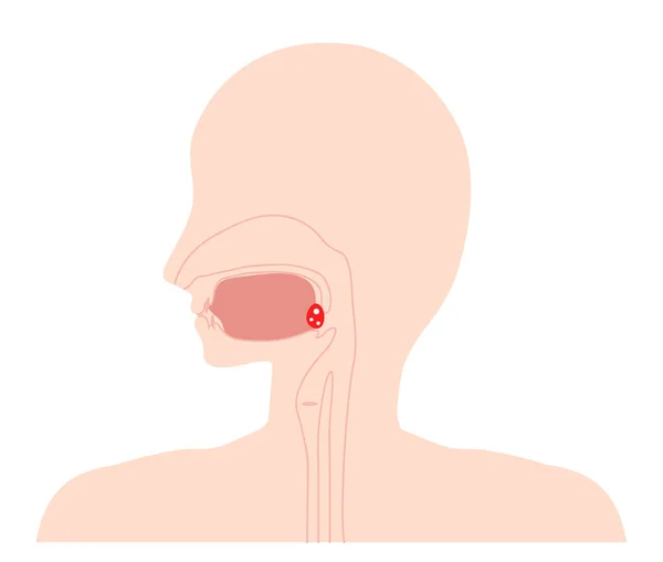 Amigdalitis Inflamación Dolor Ilustración — Vector de stock