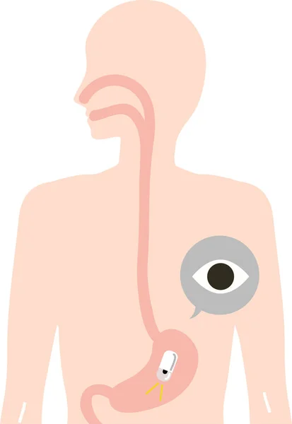 Gastroscopia Una Cápsula Ilustración Del Examen — Vector de stock