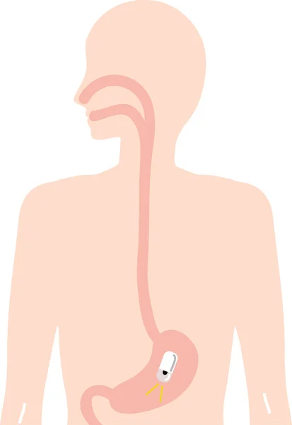 Gastroscopia Una Cápsula Ilustración Del Examen — Vector de stock