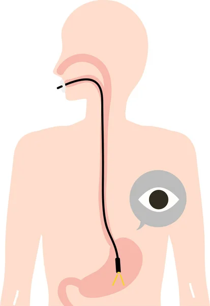 Ilustración Del Examen Gastroscopia — Vector de stock