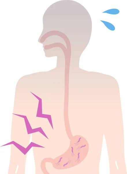 Pylori Människokroppen Magen Illustration — Stock vektor