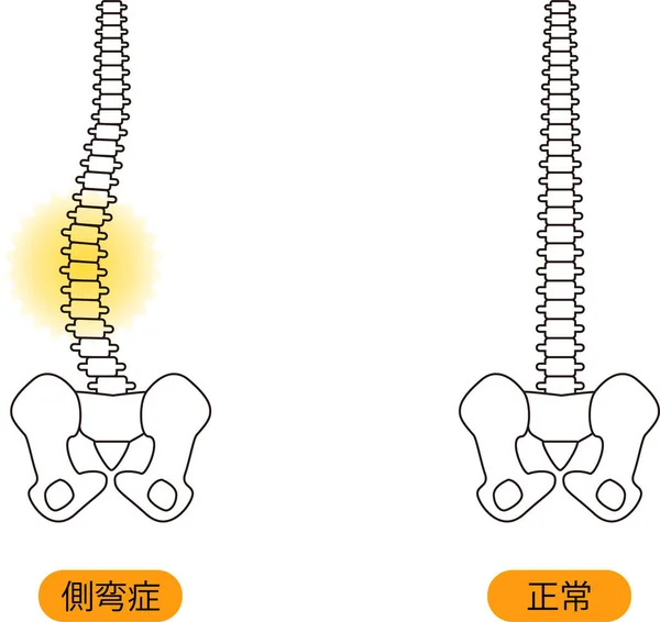 Medical Posture Scoliosis Bone Upper Body Back Illustration — Stock Vector