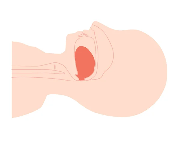Sleep Apnea Illustration Tongue Dropping — Stock Vector