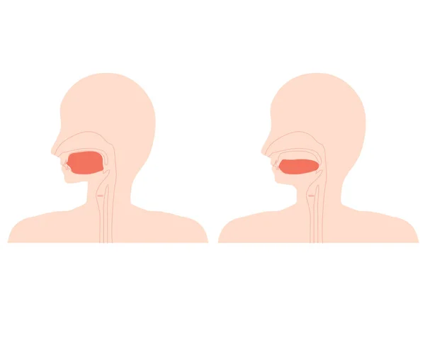 正しい舌位置と低い舌 通常の位置ではない舌 のイラスト — ストックベクタ