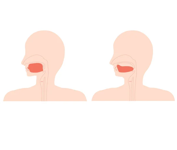 显示正确的舌位置及舌低 舌不在正常位置 — 图库矢量图片