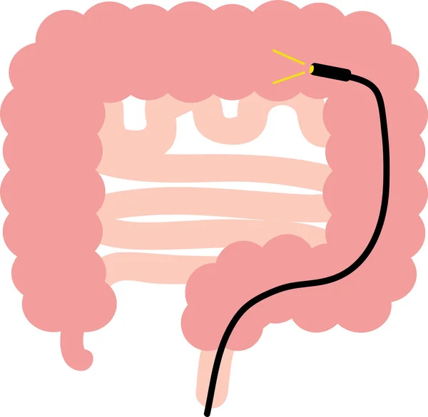 大腸内視鏡を描いたイラスト — ストックベクタ