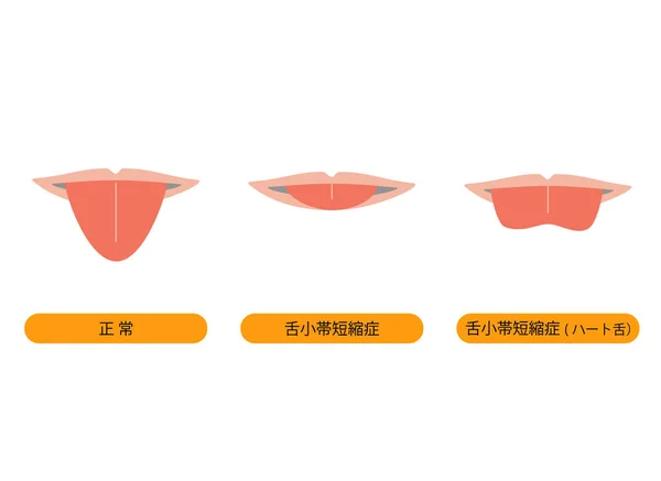 Velofaringeal Kısalma Nedeniyle Genişletilmiş Kalp Şeklindeki Bir Dilin Tasviri — Stok Vektör