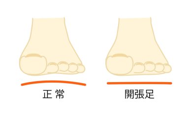 Normal ve açık ayak parmaklarının tasviri.