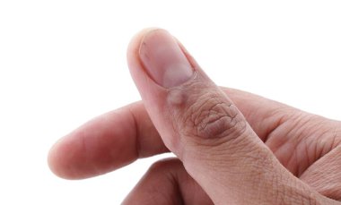 Tıbbi terimlerde siğillere Papillomas denir. Papilloma aslında ciltteki iyi huylu bir tümördür. Derinin aşırı kalınlaşmasından kaynaklanır.. 