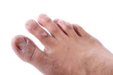 Tıbbi terimlerde siğillere Papillomas denir. Papilloma aslında ciltteki iyi huylu bir tümördür. Derinin aşırı kalınlaşmasından kaynaklanır.. 