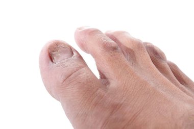 Tıbbi terimlerde siğillere Papillomas denir. Papilloma aslında ciltteki iyi huylu bir tümördür. Derinin aşırı kalınlaşmasından kaynaklanır.. 