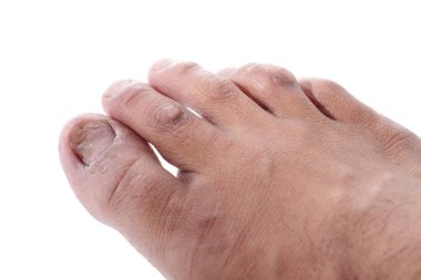 Tıbbi terimlerde siğillere Papillomas denir. Papilloma aslında ciltteki iyi huylu bir tümördür. Derinin aşırı kalınlaşmasından kaynaklanır.. 