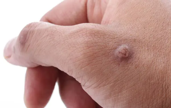 Warts in medical terms are called Papillomas. Papilloma is actually a type of benign tumor on the skin, originating from excessive thickening of the outer layer of the skin.