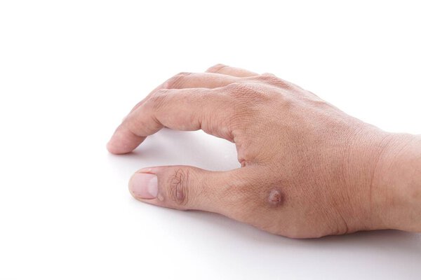 Warts in medical terms are called Papillomas. Papilloma is actually a type of benign tumor on the skin, originating from excessive thickening of the outer layer of the skin. 