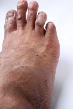 cilt derisi iltihabı