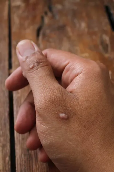 a man 's skin, a person 's finger is on the skin. close - up