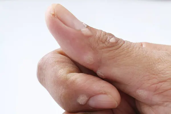 Fechar Uma Mão Com Dedo Dolorido — Fotografia de Stock