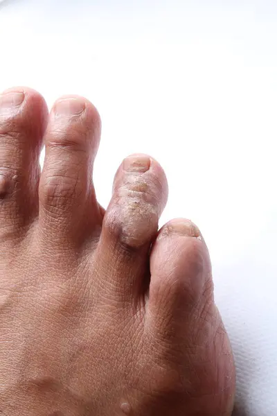Foot Man Suffering Disease — Stock Photo, Image
