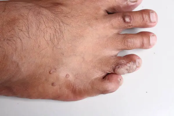 close up of a man \'s feet with a broken skin.