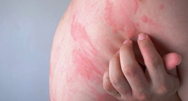 Close up image of skin texture suffering severe urticaria or hives or kaligata on back. Allergy symptoms. clipart