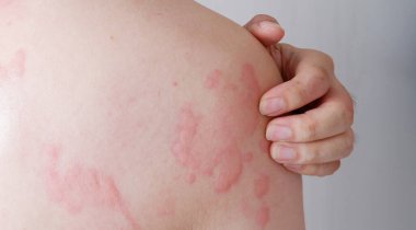 Close up image of skin texture suffering severe urticaria or hives or kaligata on back. Allergy symptoms.