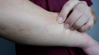 Close up image of man arm suffering severe urticaria or hives. Allergy symptoms.