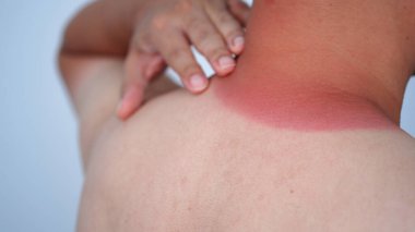 redness on the man neck of sunburn, close-up view