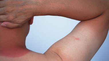 redness on the man neck of sunburn, close-up view