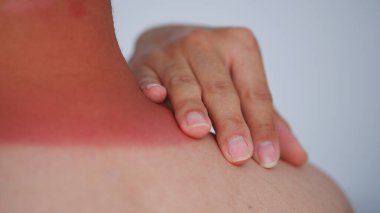 redness on the man neck of sunburn, close-up view