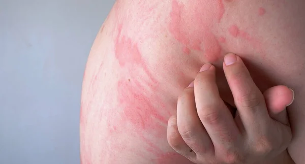 Close up image of skin texture suffering severe urticaria or hives or kaligata on back. Allergy symptoms.