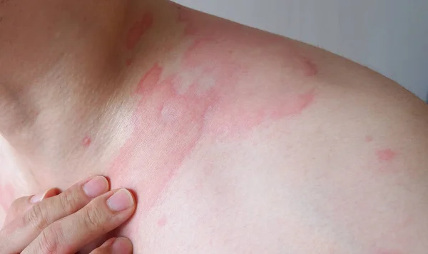 Close up image of skin texture suffering severe urticaria or hives or kaligata on back. Allergy symptoms.