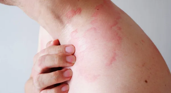Close up image of skin texture suffering severe urticaria or hives or kaligata on back. Allergy symptoms.